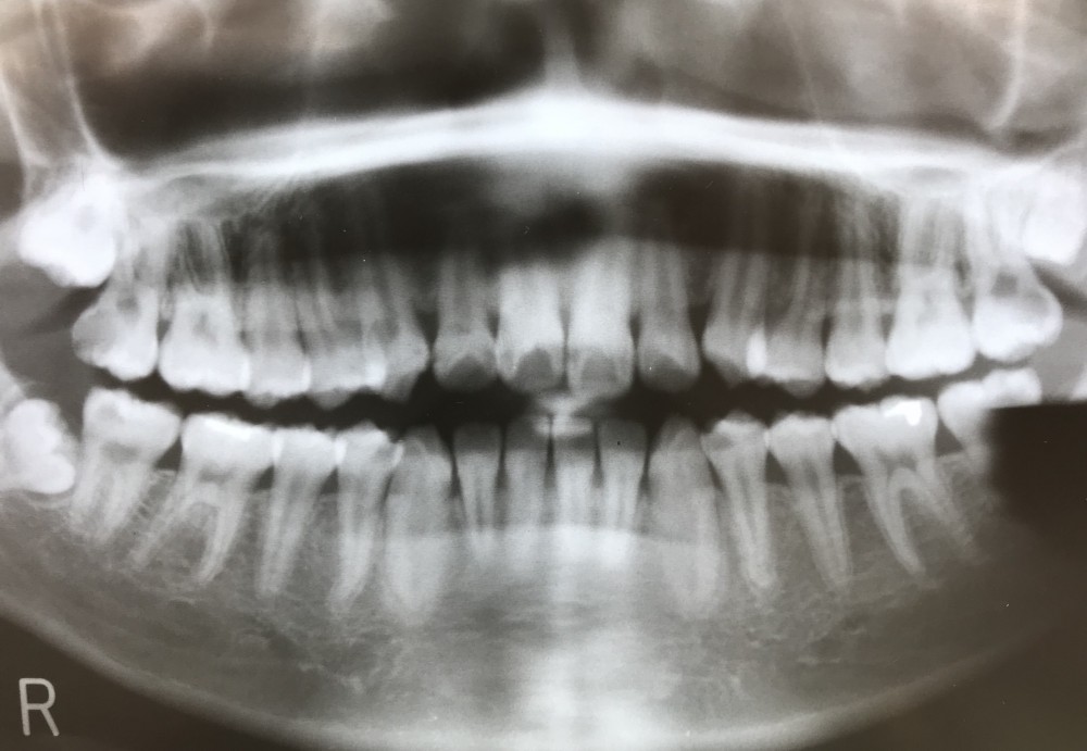 【親知らず】の活用法