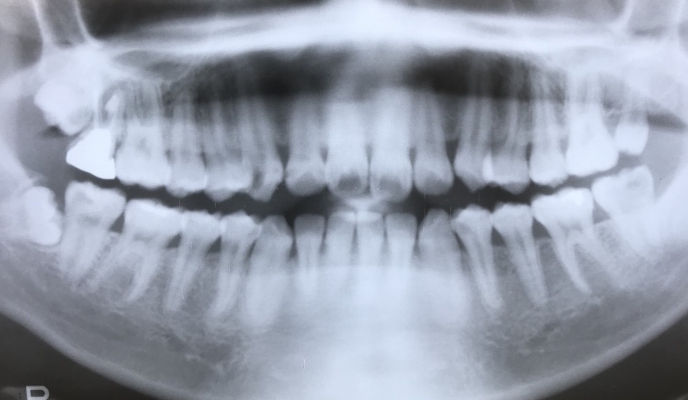 【親知らず】の活用法