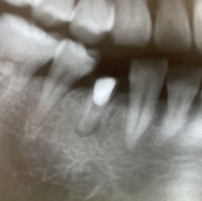 【根管治療】11年経過症例