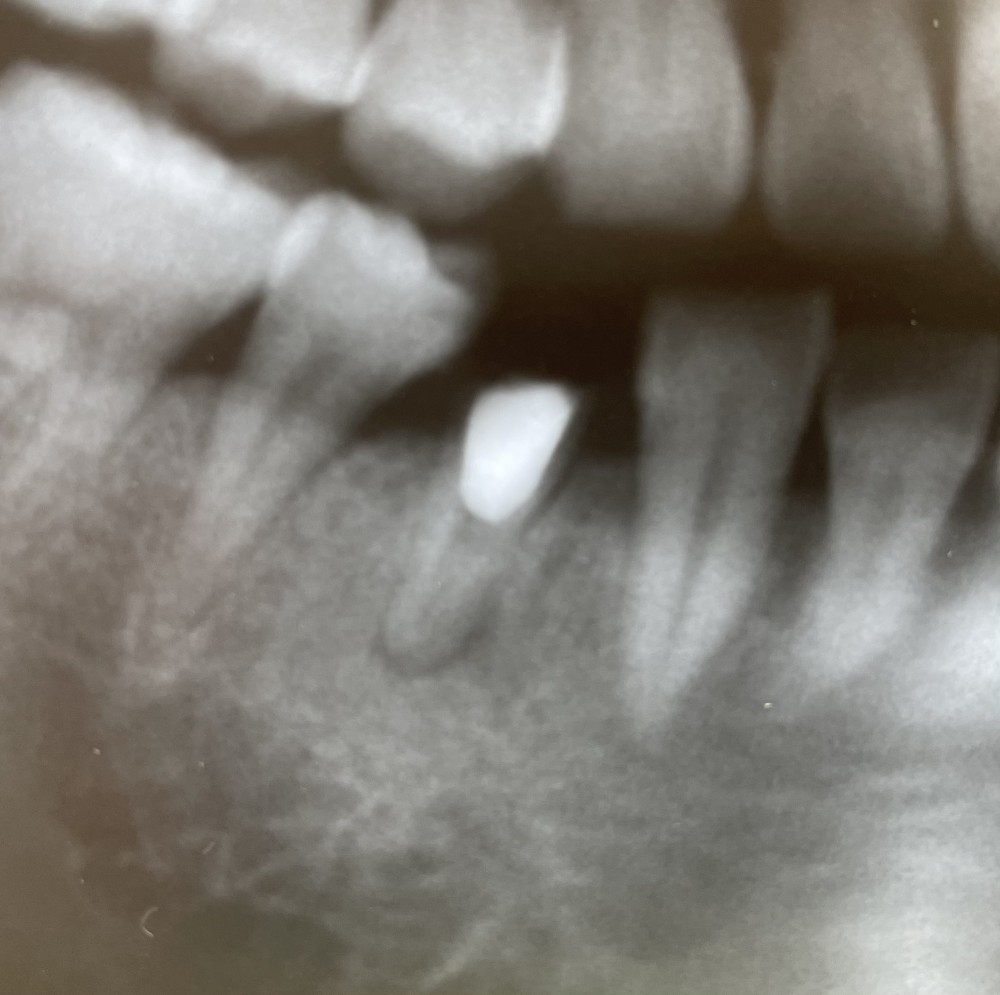 【根管治療】11年経過症例