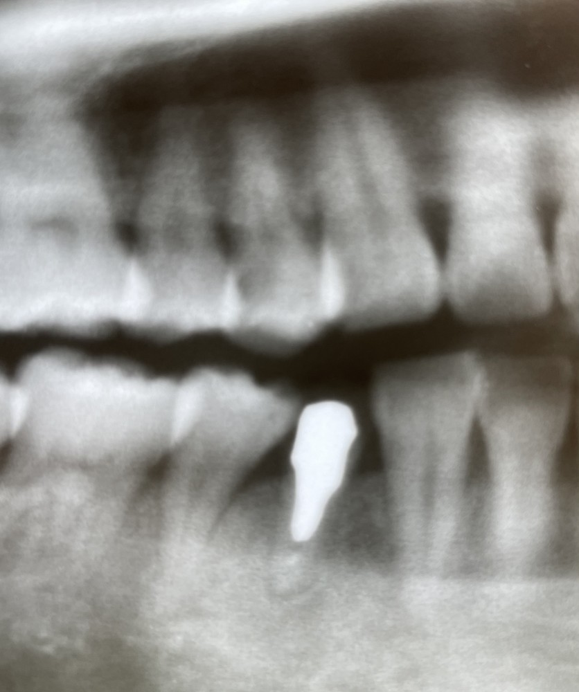 【根管治療】11年経過症例