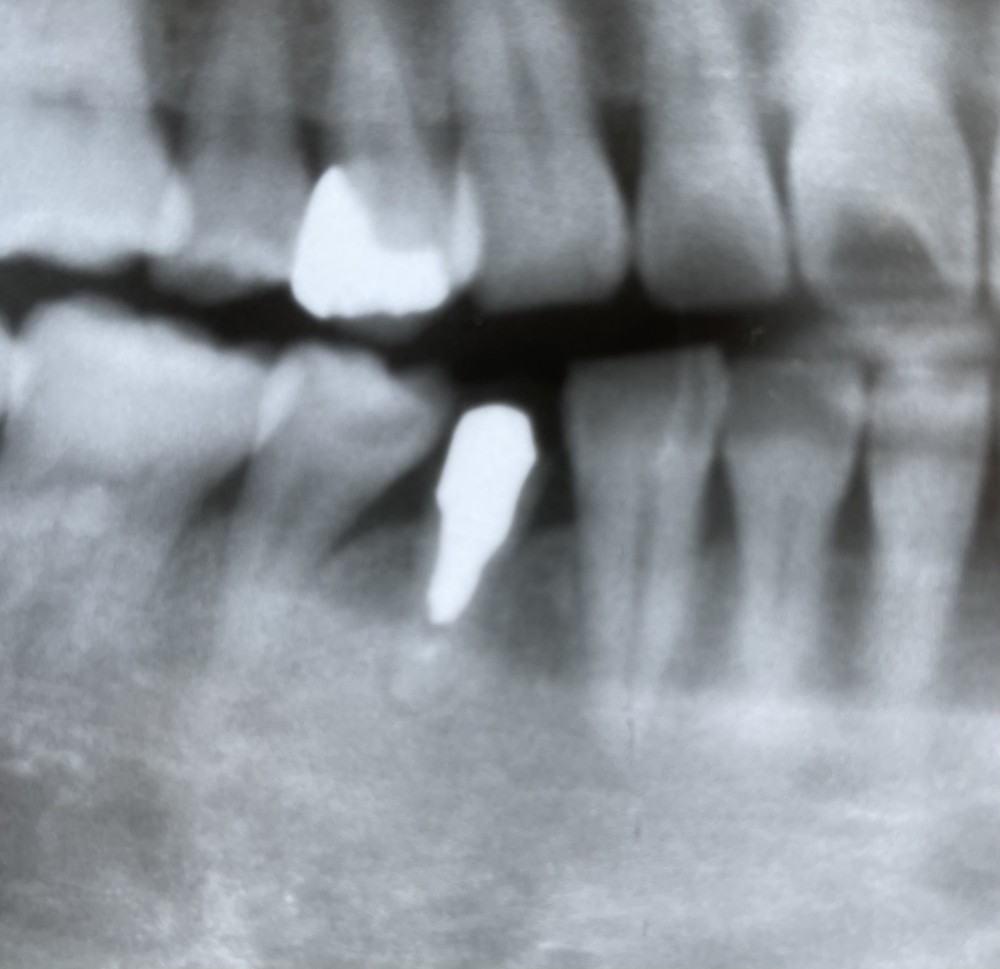 【根管治療】11年経過症例