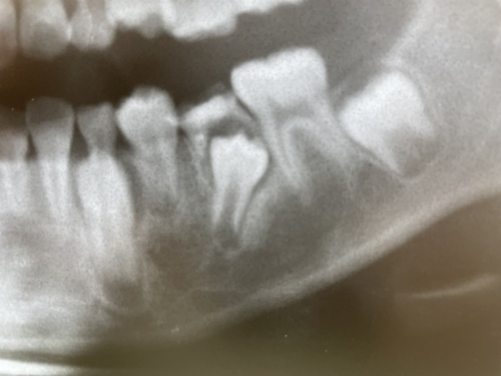 【乳歯抜歯のタイミング】