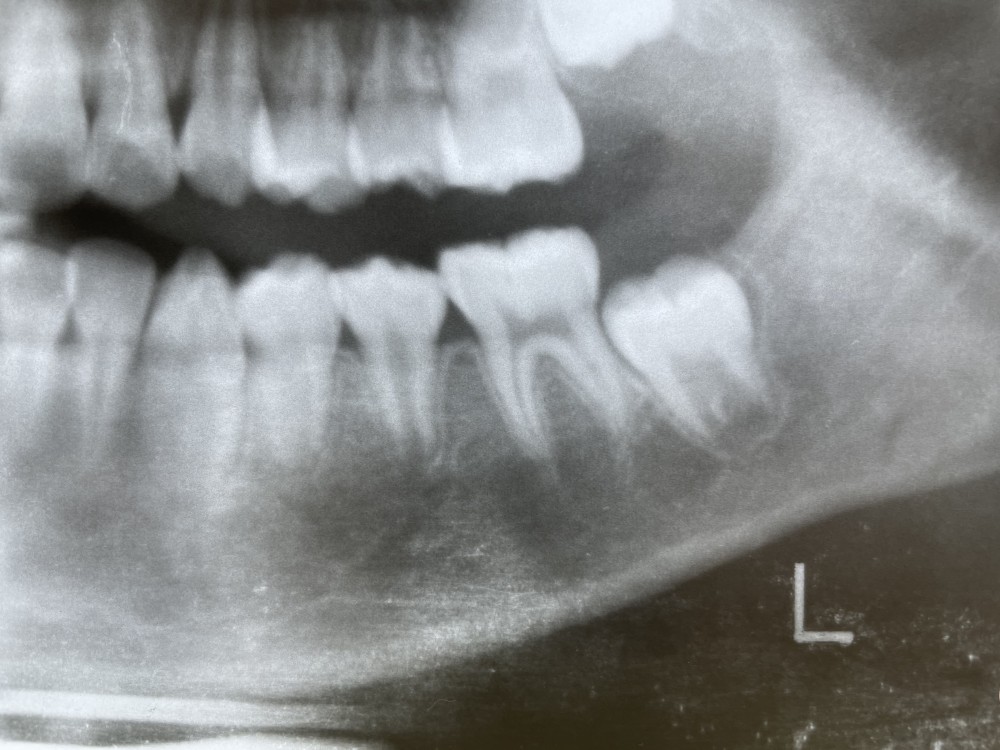 【乳歯抜歯のタイミング】