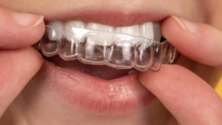 実例写真【ホームホワイトニング】