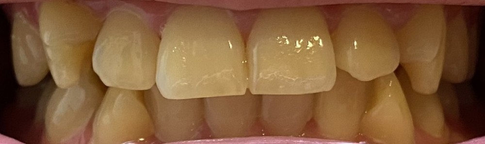 実例写真【ホームホワイトニング】