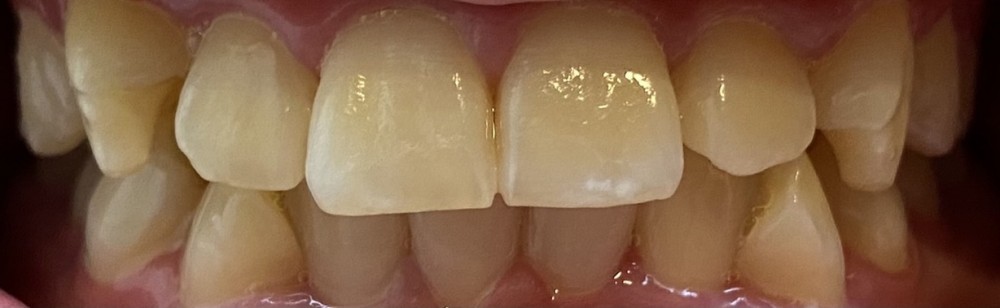 実例写真【ホームホワイトニング】