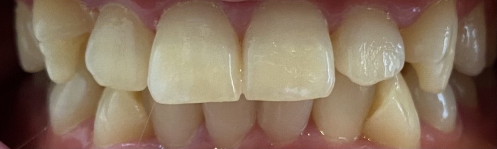 実例写真【ホームホワイトニング】