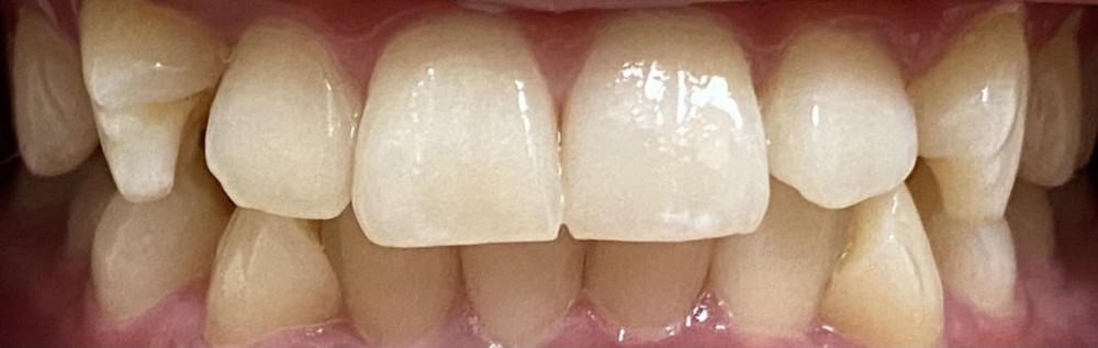 実例写真【ホームホワイトニング】