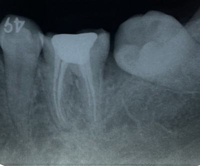根管治療【狭窄根管、湾曲根管】