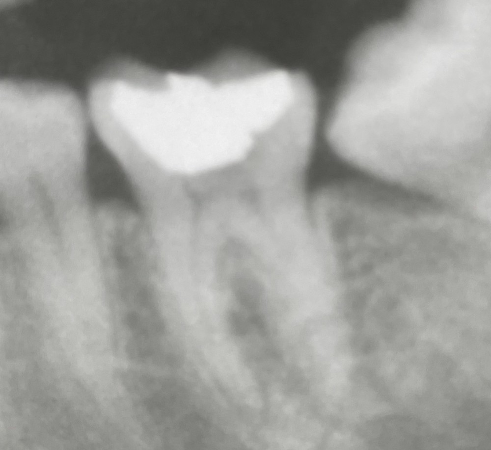 根管治療【狭窄根管、湾曲根管】