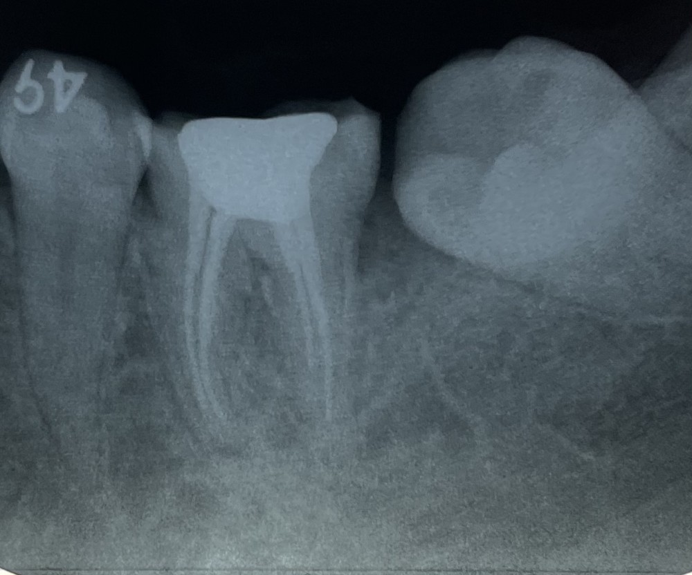 根管治療【狭窄根管、湾曲根管】
