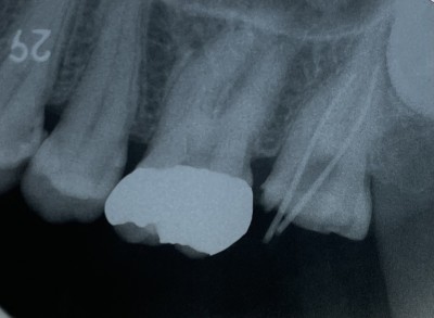 根管治療【上顎第二大臼歯】