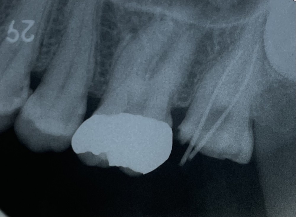 根管治療【上顎第二大臼歯】