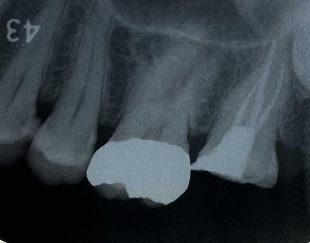根管治療【上顎第二大臼歯】