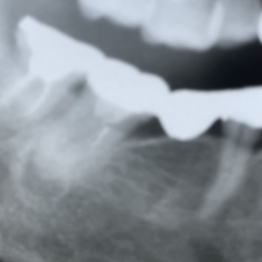 症例紹介【破折したファイルの除去】