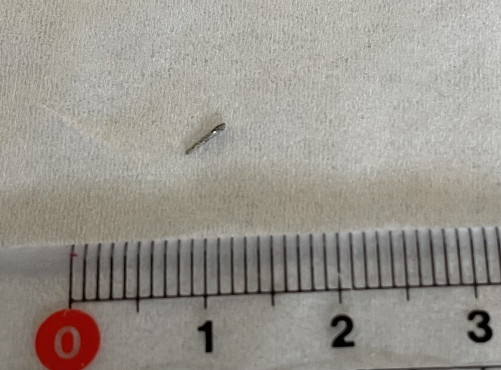 症例紹介【破折したファイルの除去】