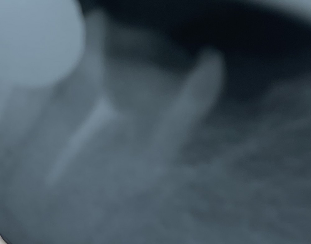 症例紹介【破折したファイルの除去】