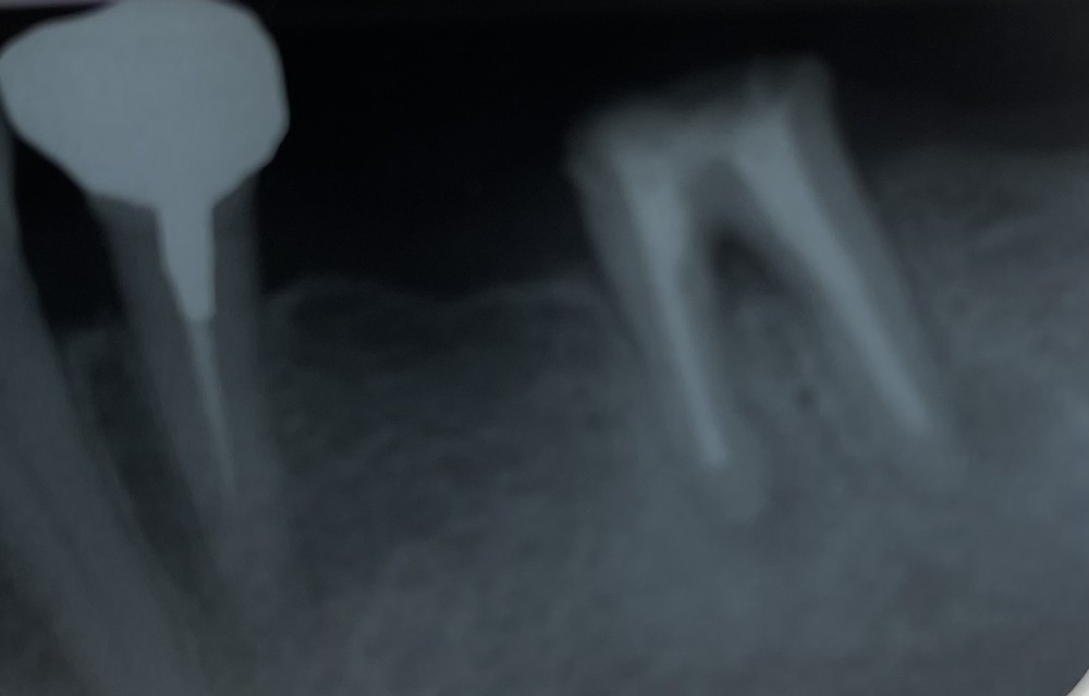 【根管治療】メタルコア除去、感染根管