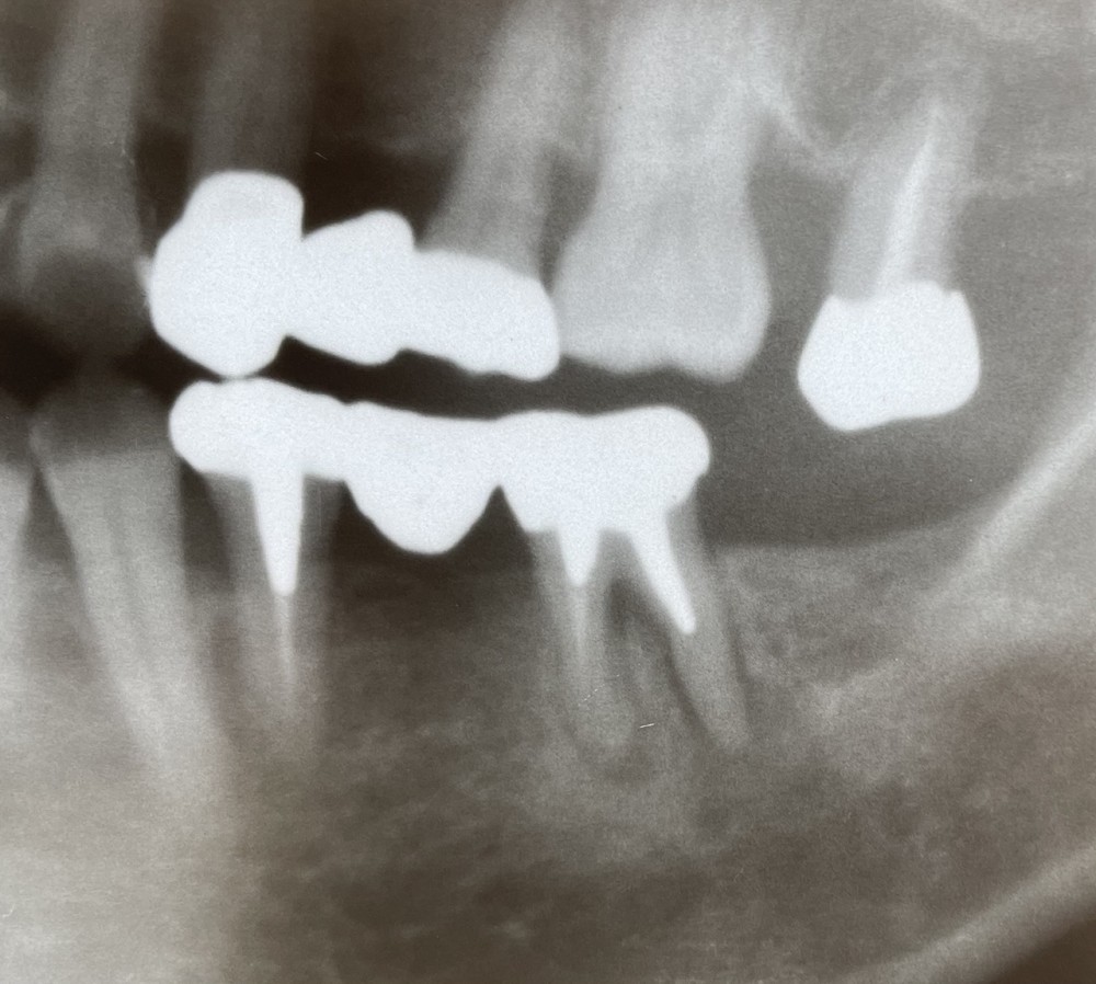 【根管治療】メタルコア除去、感染根管