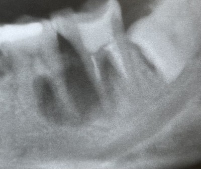 【原因不明の根尖病巣】