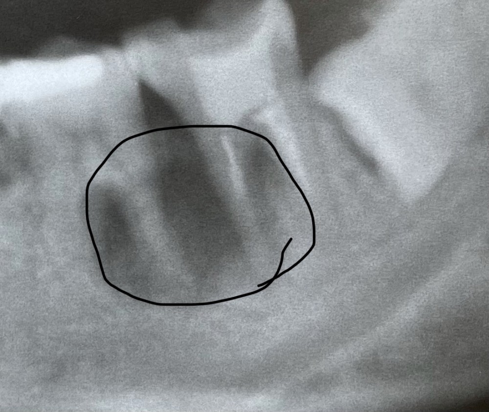 【原因不明の根尖病巣】