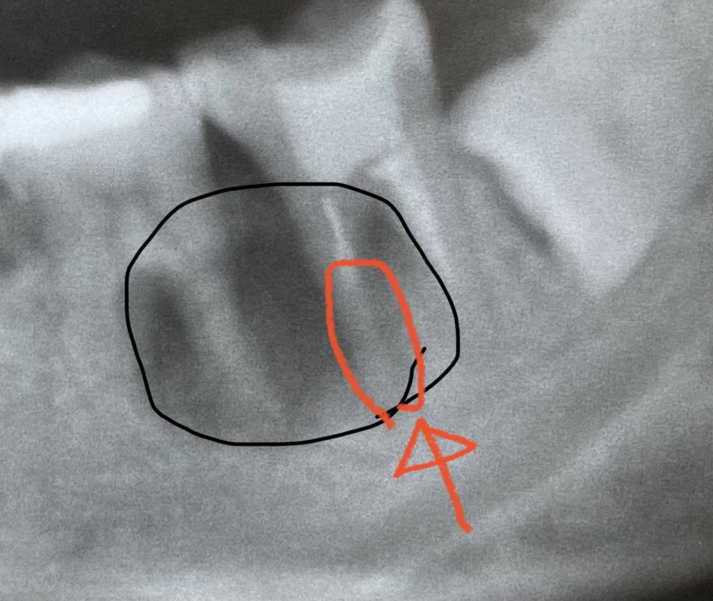 【原因不明の根尖病巣】