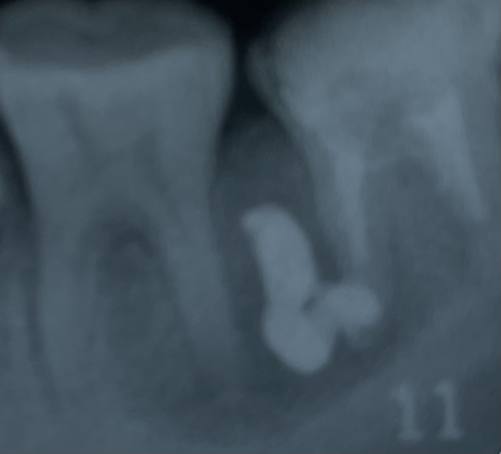 【原因不明の根尖病巣】