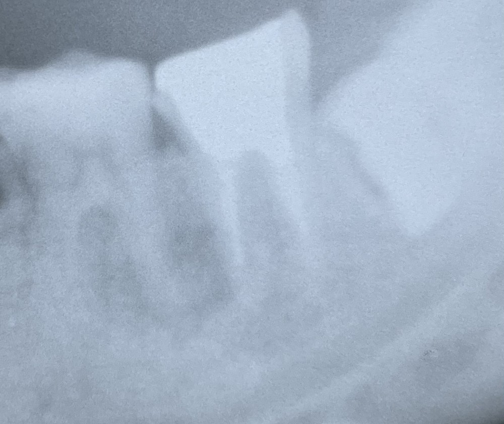 【原因不明の根尖病巣】