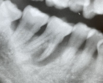 【歯根分割からの単冠補填】