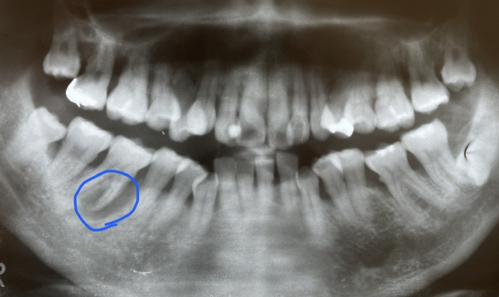 【歯根分割からの単冠補填】