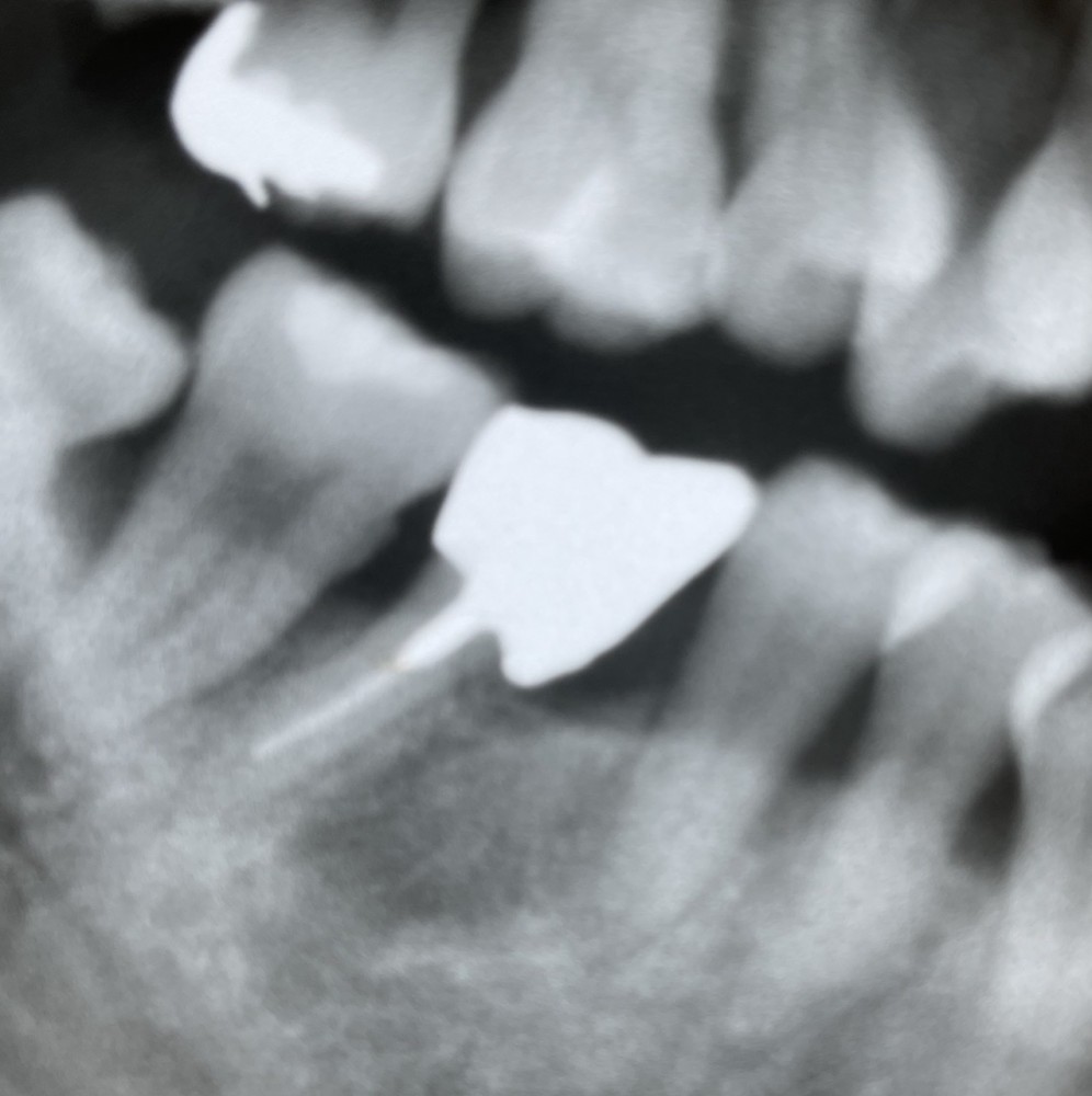 【歯根分割からの単冠補填】