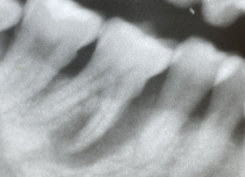 【歯根分割からの単冠補填】