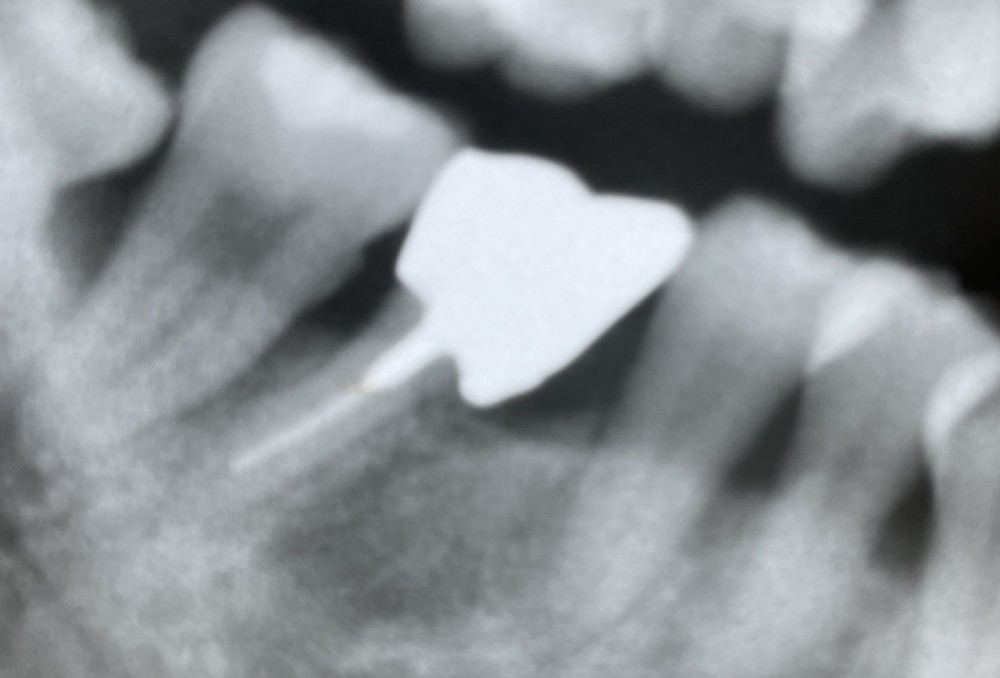 【歯根分割からの単冠補填】