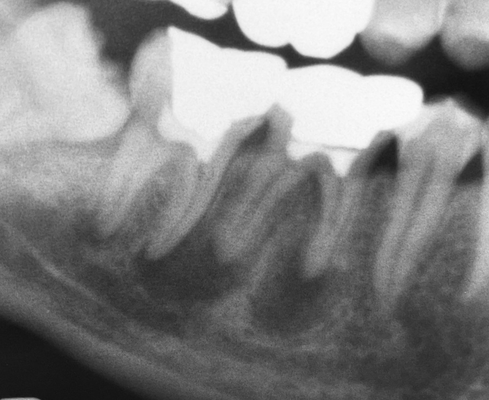【下顎大臼歯根管治療】