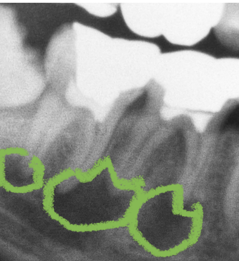 【下顎大臼歯根管治療】
