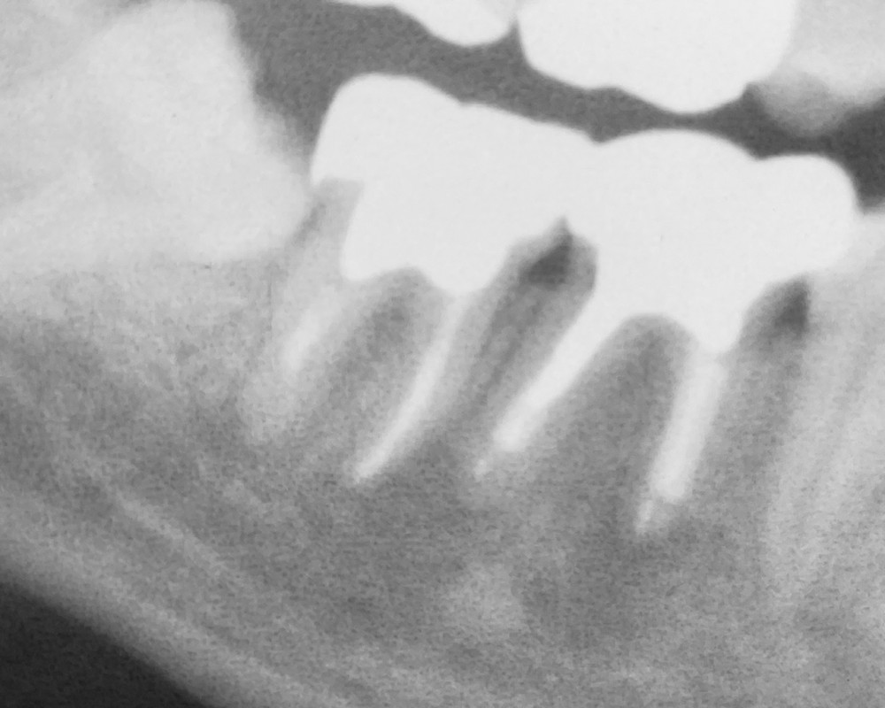【下顎大臼歯根管治療】