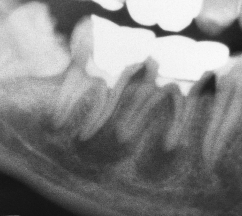 【下顎大臼歯根管治療】