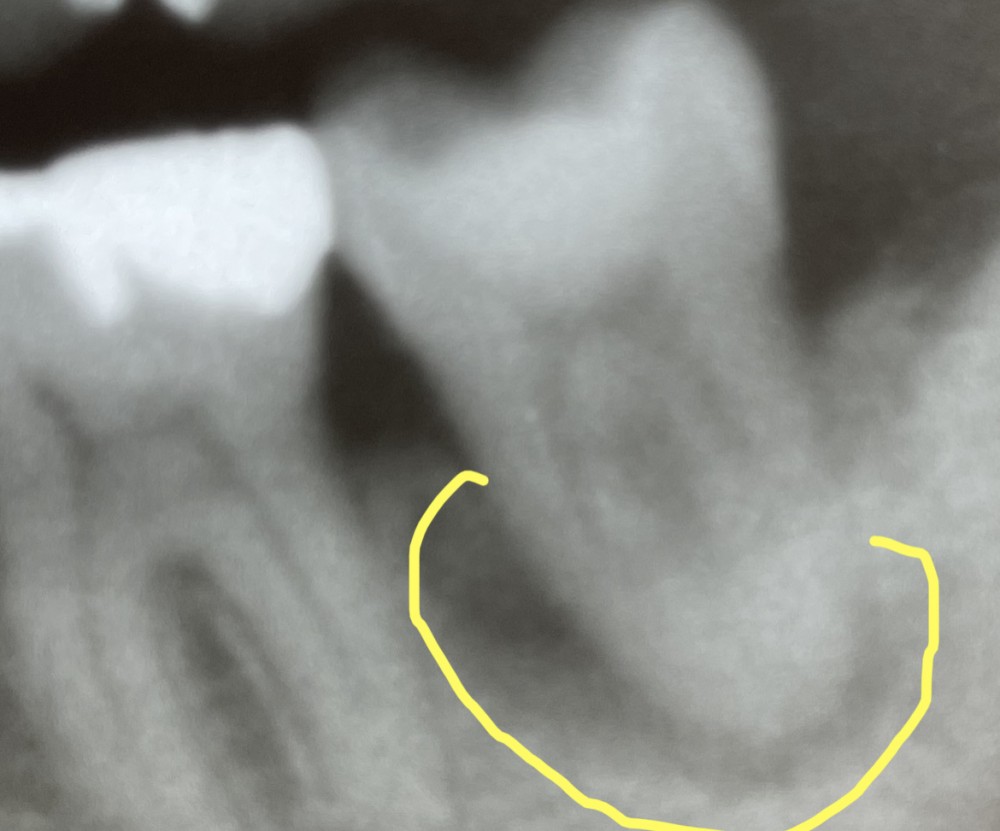 【下顎第二大臼歯】根管治療2年経過