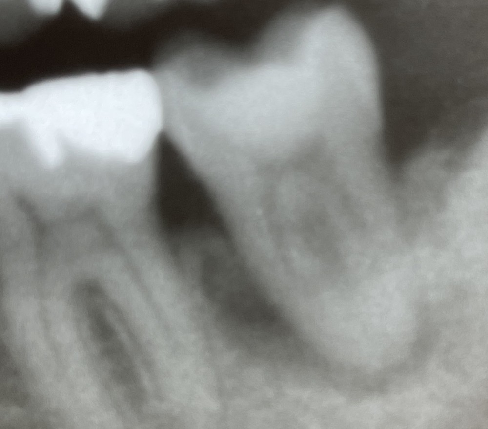 【下顎第二大臼歯】根管治療2年経過