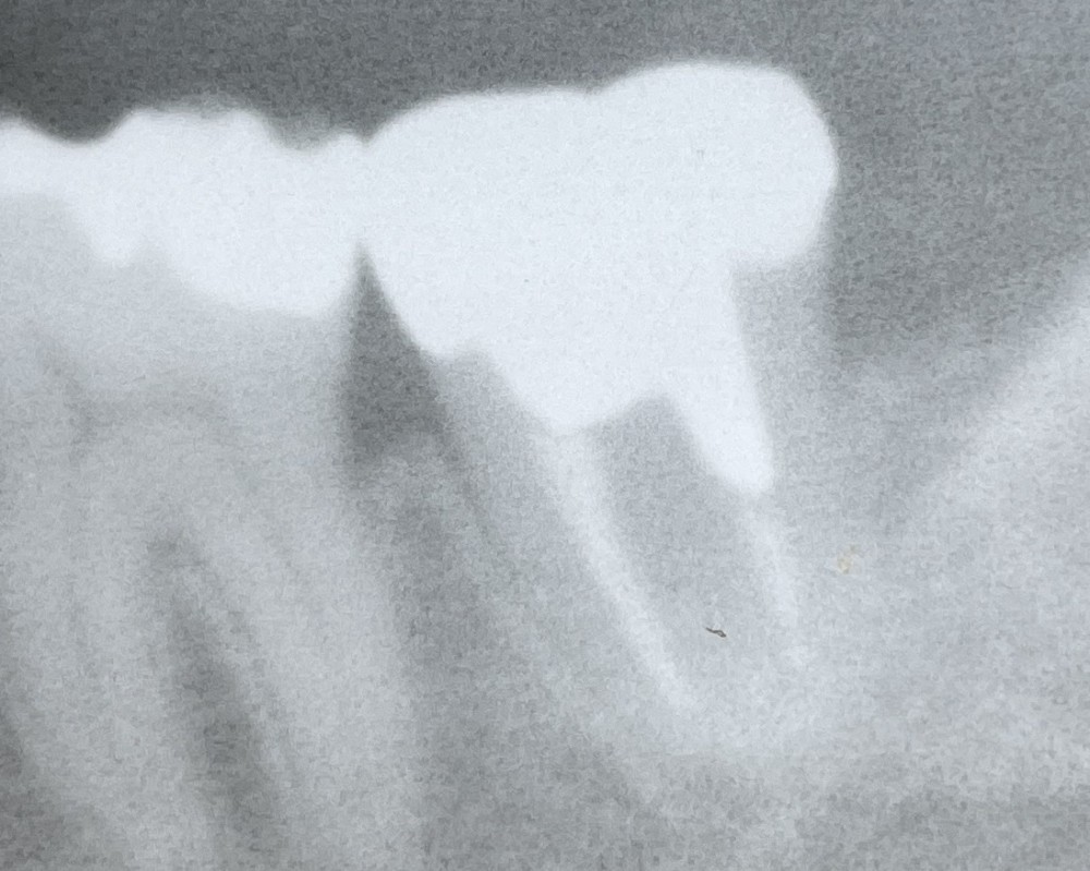 【下顎第二大臼歯】根管治療2年経過