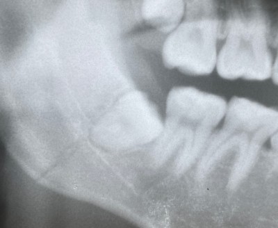 [下顎骨の骨折の3年経過】