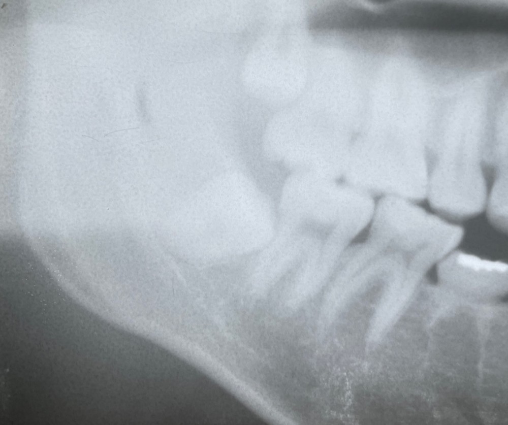 ［下顎骨の骨折の3年経過】