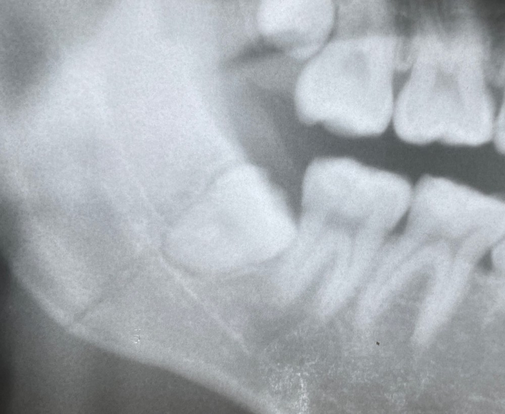 ［下顎骨の骨折の3年経過】