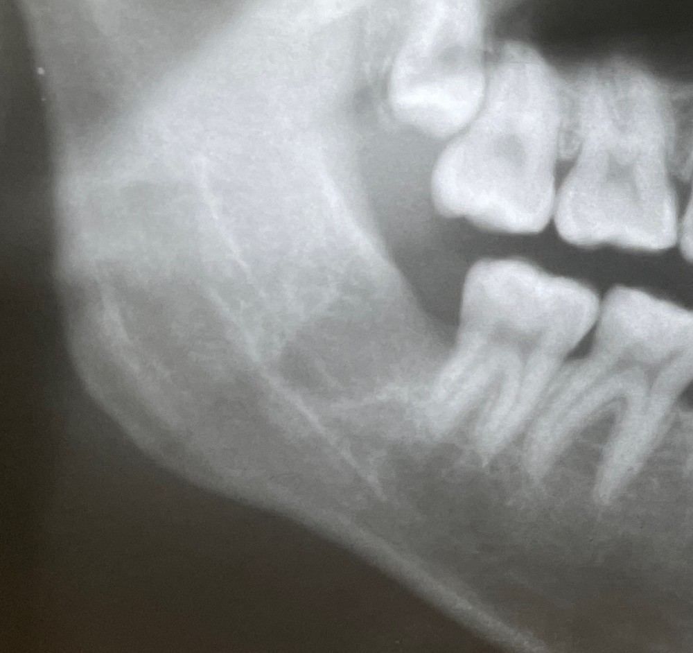 ［下顎骨の骨折の3年経過】