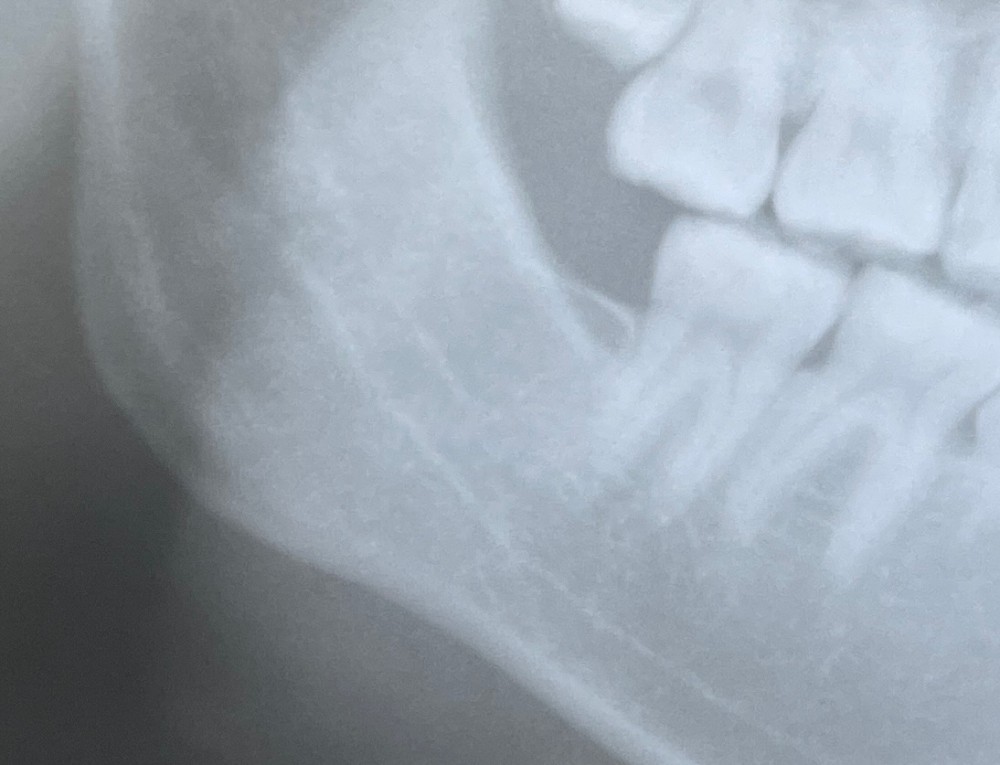 ［下顎骨の骨折の3年経過】