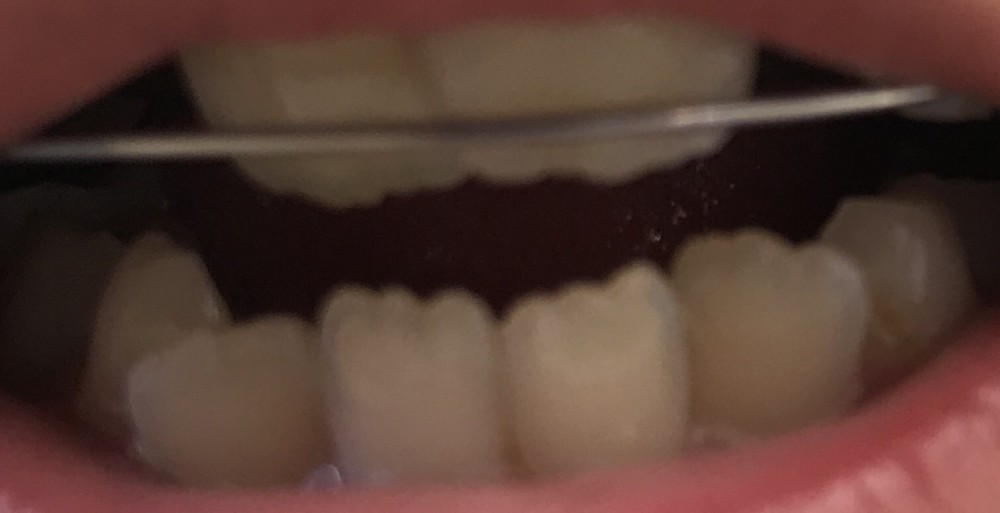 【混合歯列期の床矯正】