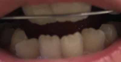 【混合歯列期の床矯正】