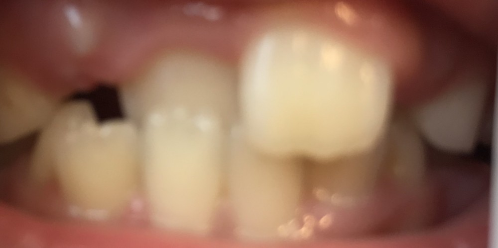 【混合歯列期の床矯正】