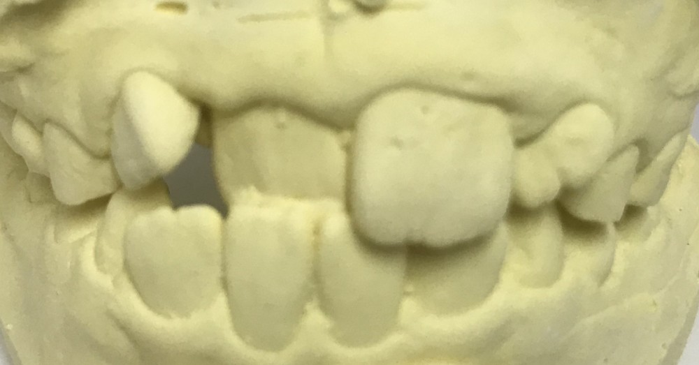 【混合歯列期の床矯正】